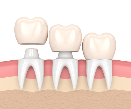 Diagram showing the placement of a traditional dental crown