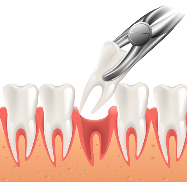 Cartoon rendering of a dental extraction