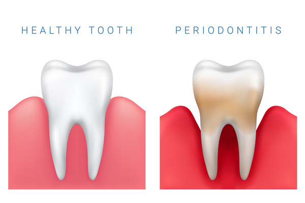 A healthy tooth compared to a tooth with periodontal disease